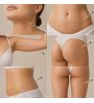 Zone lipoliză injectabilă: bărbie, abdomen, flancuri, brațe, coapse, subfesier.